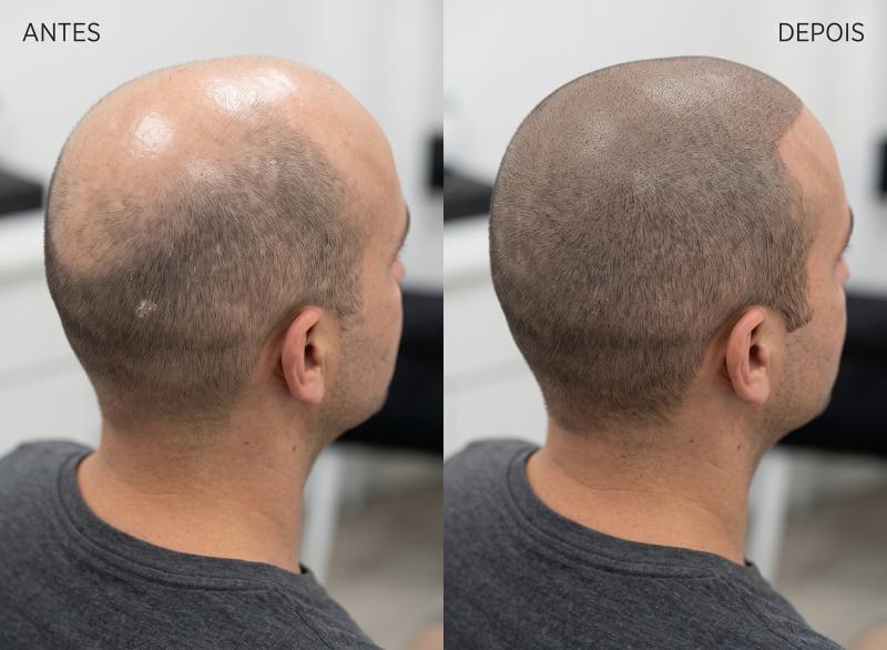 Clínicas de pigmentação capilar: Transforme Seu Visual Instantaneamente