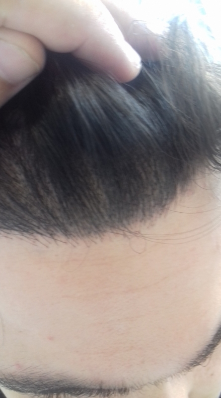 Micropigmentação Capilar Feminina Itanhaém - Micropigmentação Capilar em Entradas Micropigmentação Capilar Feminina Itanhaém - Micropigmentação Capilar em Entradas
