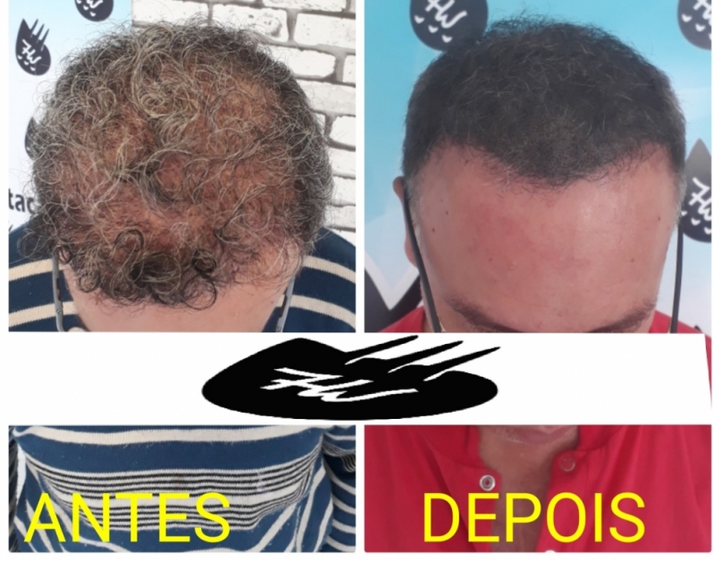 Clínica de Micropigmentação Cabelo Masculino Guarujá - Micropigmentação Cabelo Masculino