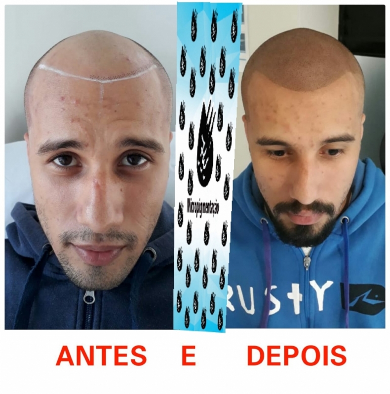 Clínica de Micropigmentação Capilar em 3d Mairiporã - Clínica de Pigmentação de Cabelo Masculino