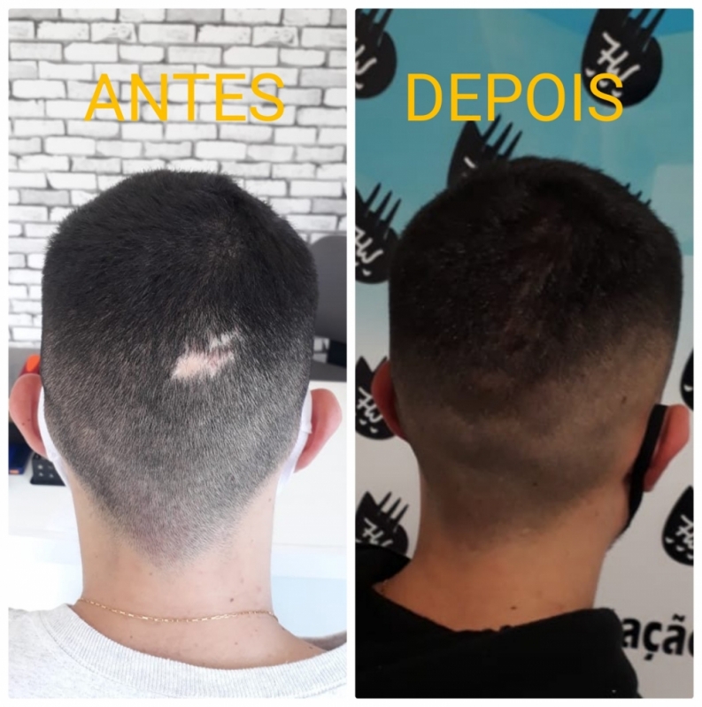 Clínica de Micropigmentação Capilar Realista Aclimação - Micropigmentação Capilar Cabelo Grande