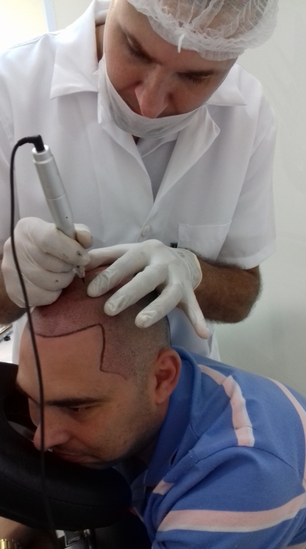 Clínica de Micropigmentação Capilar Osasco - Clínica de Pigmentação na Careca