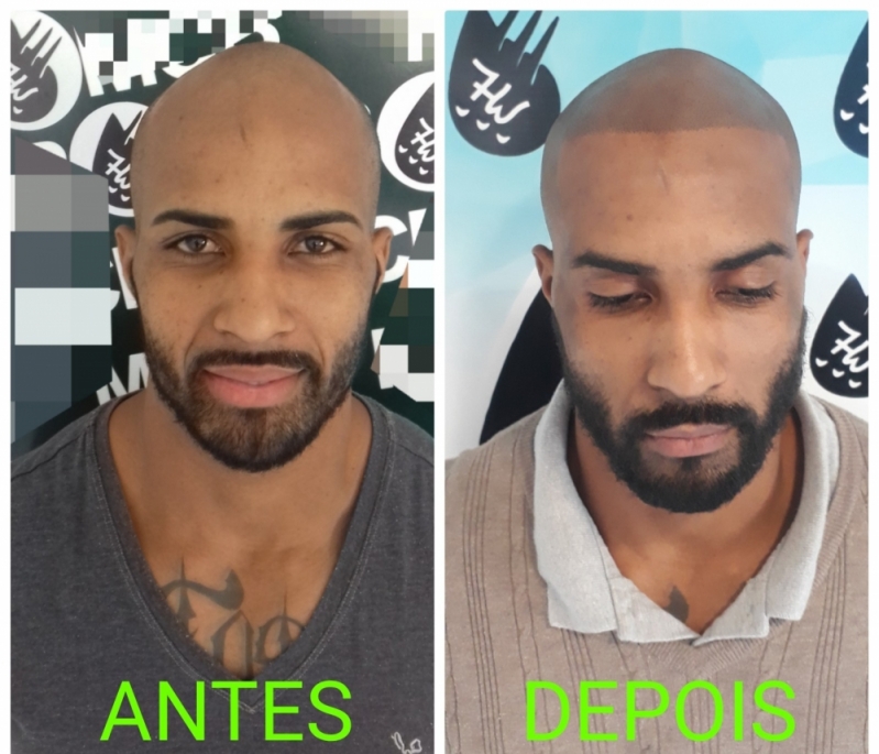 Clínica de Micropigmentação de Cabelo 3d São Mateus - Micropigmentação Cabelo Homem