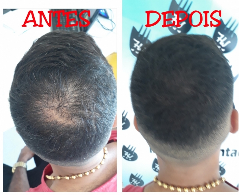 Clínica de Micropigmentação de Cabelo Masculino Pedreira - Micropigmentação Preenchimento Cabelo