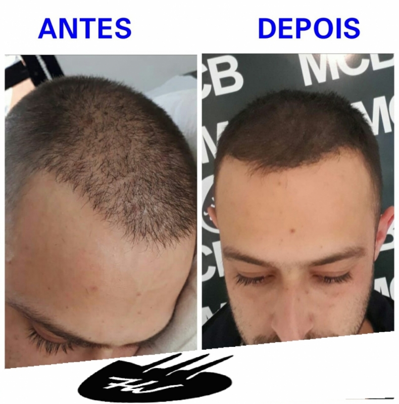 Clínica de Micropigmentação em Sp Jardim Paulistano - Clínica de Pigmentação na Careca