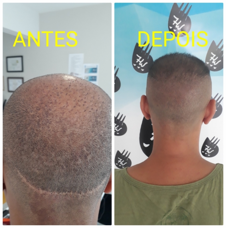 Clínica de Micropigmentação Fio a Fio Cabelo Cajamar - Micropigmentação Capilar Realista