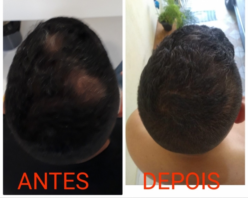 Clínica de Micropigmentação no Cabelo São Mateus - Micropigmentação Cabelo