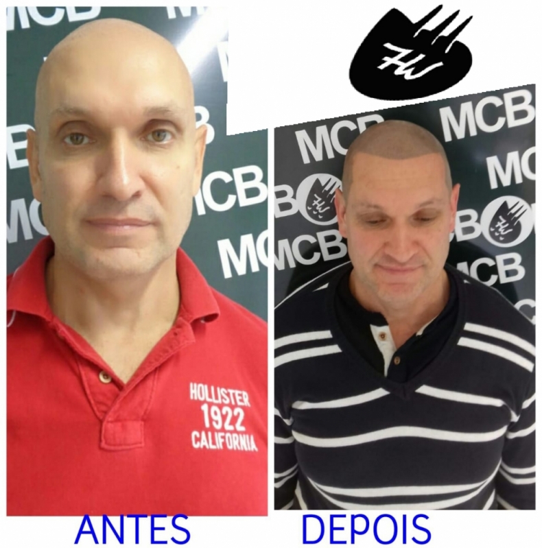 Clínica de Pigmentação Capilar Definitiva Ponte Rasa - Clínica de Pigmentação de Cabelo Masculino