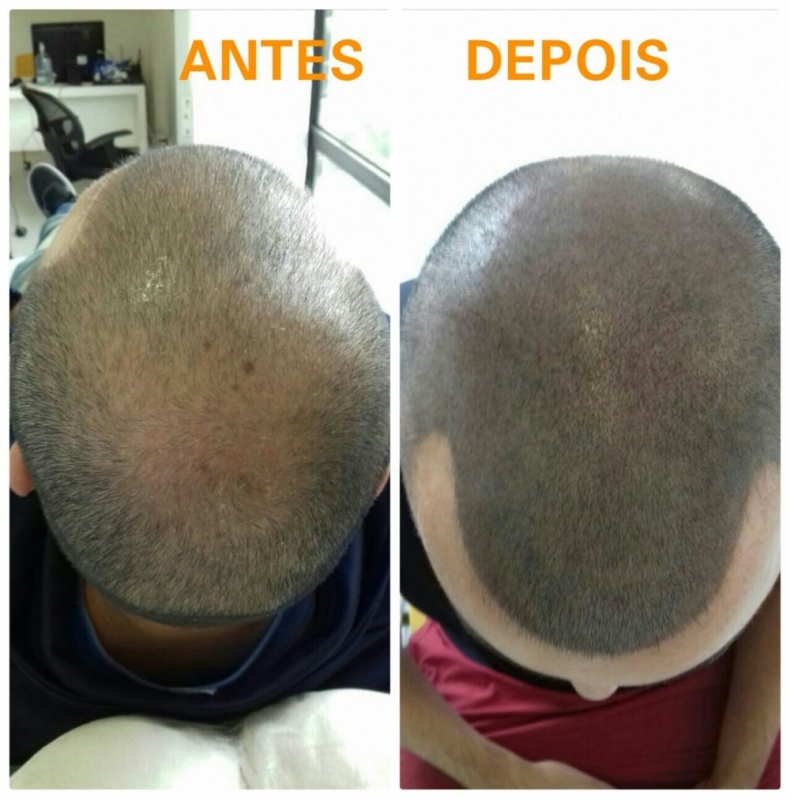 Clínica de Pigmentação Capilar para Homens em Sp Sumaré - Clínica de Pigmentação de Cabelo Masculino