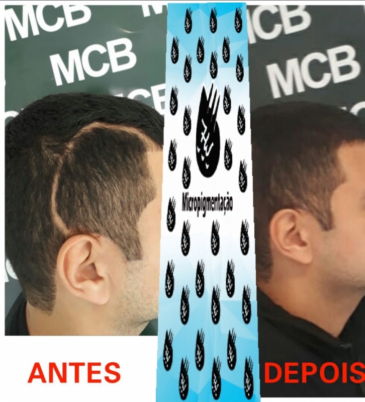 Clínica de Pigmentação de Cabelo Masculino Bertioga - Clínica de Micropigmentação Capilar