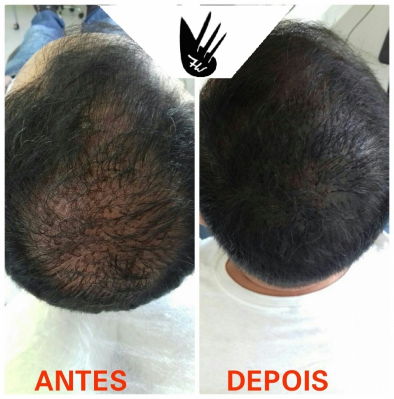 Clínica de Pigmentação de Couro Cabeludo Bairro do Limão - Clínica de Pigmentação de Cabelo Masculino