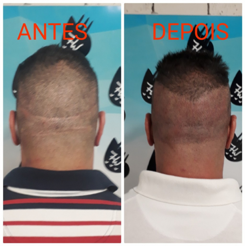 Clinica Que Faz Nano Micropigmentação Capilar Jundiaí - Nano Pigmentação da Barba São Caetano do Sul