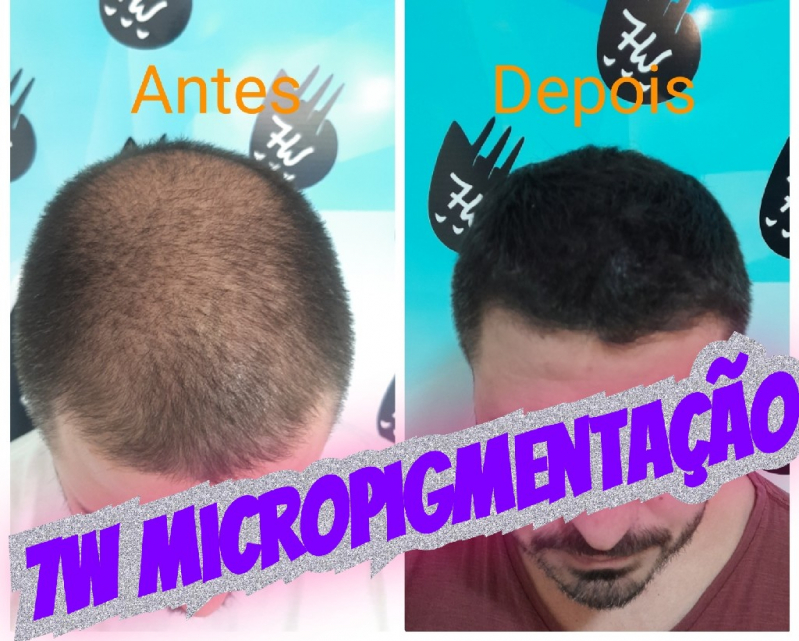 Clinica Que Faz Nano Pigmentação Cabelo Taboão da Serra - Nano Pigmentação de Barba ABC Paulista