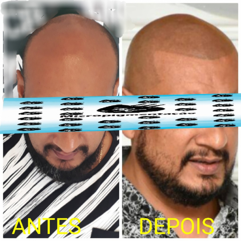 Clinica Que Faz Nano Pigmentação Capilar Vila Maria - Nano Micropigmentação na Barba Diadema