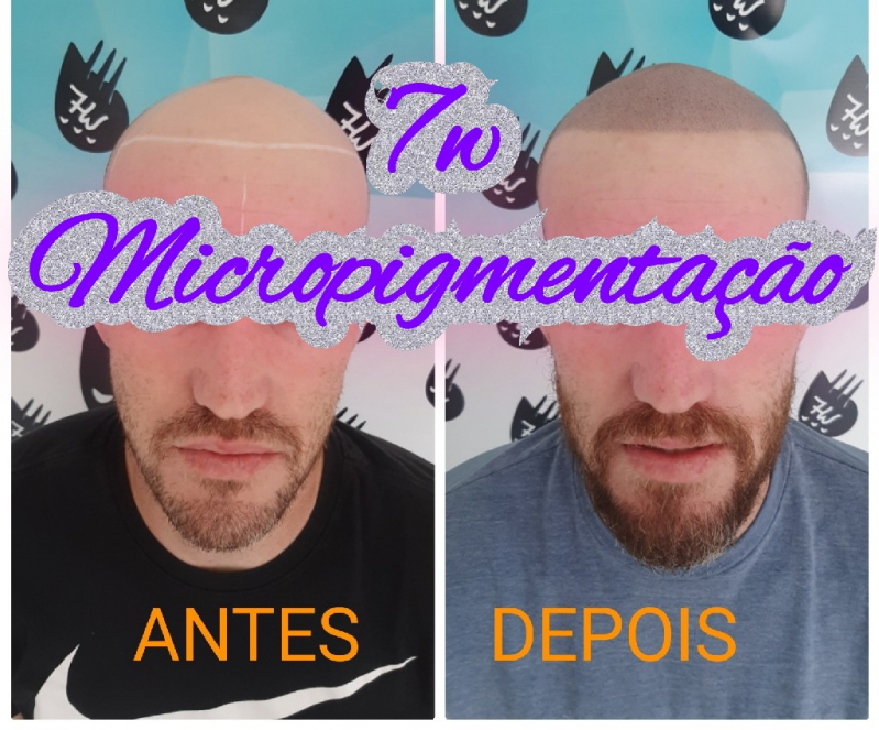 Clinica Que Faz Nano Pigmentação no Cabelo Poá - Nano Micropigmentação Capilar Santo André