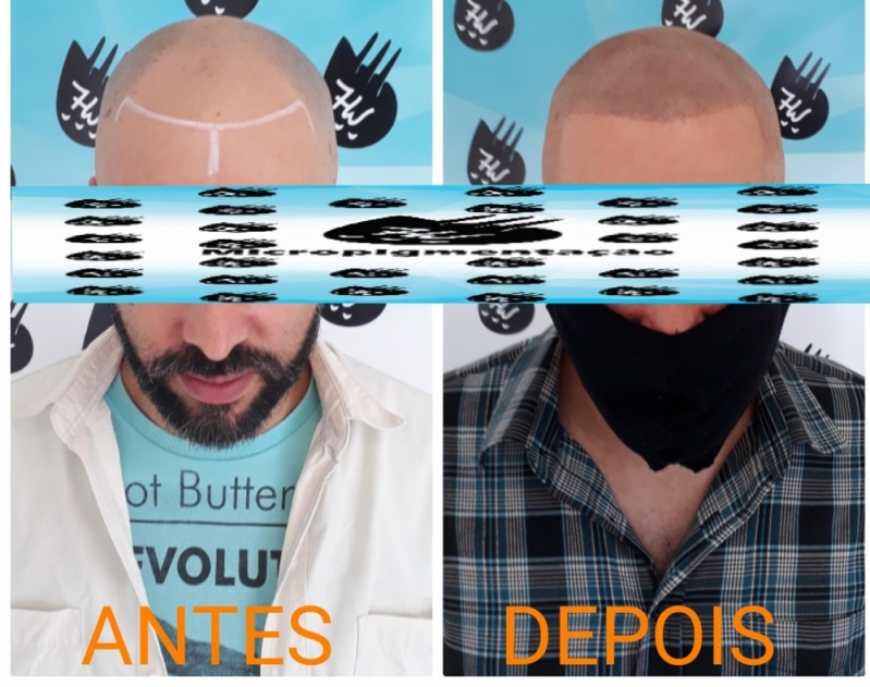 Micropigmentação Cabelo Homem Jardim Bonfiglioli - Micropigmentação Capilar Fio a Fio