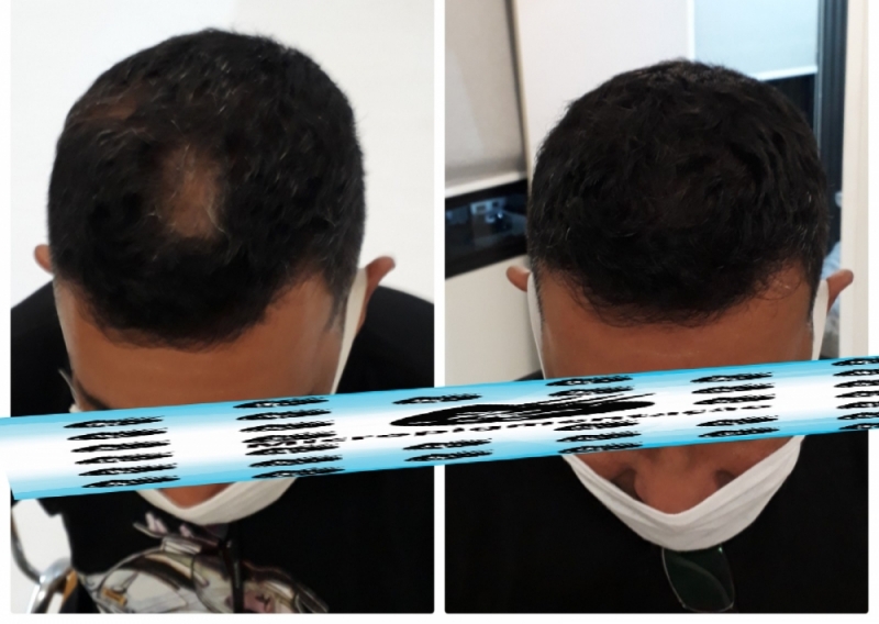 Micropigmentação Cabelo Masculino Agendar Pedreira - Micropigmentação Preenchimento Cabelo