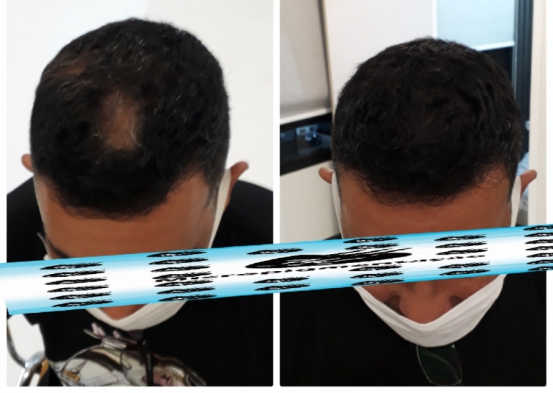 Micropigmentação Cabelo Masculino Agendar Caieiras - Micropigmentação Capilar Realista