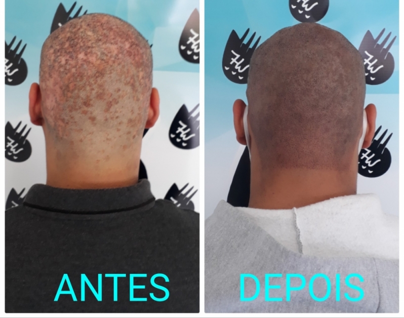 Micropigmentação Cabelo Masculino Pinheiros - Micropigmentação Capilar Realista