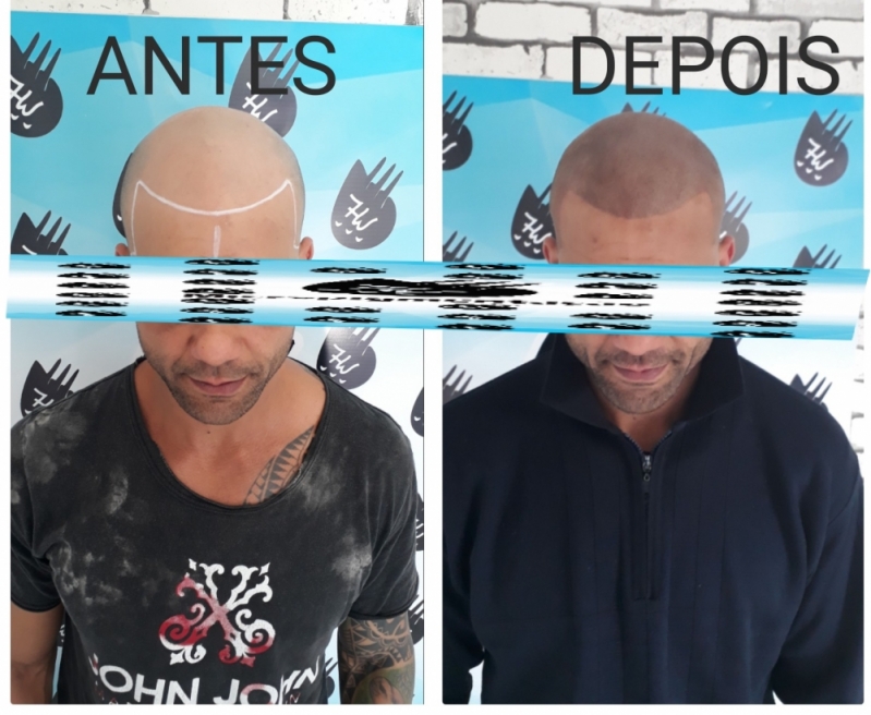 Micropigmentação Cabelo Preço Mogi das Cruzes - Micropigmentação Cabelo Masculino