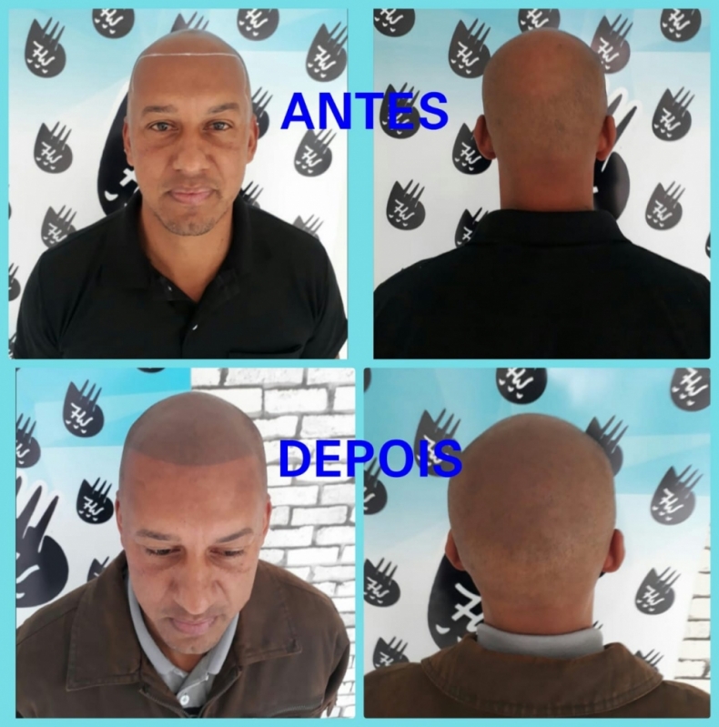Micropigmentação Cabelos Agendar Lapa - Micropigmentação Capilar Cabelo Branco
