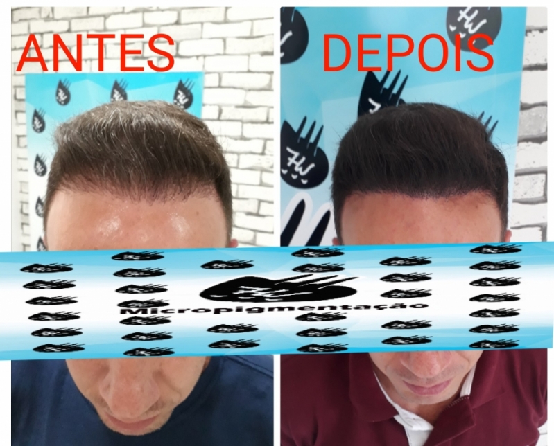 Micropigmentação Cabelos Alphaville - Micropigmentação de Cabelo Masculino