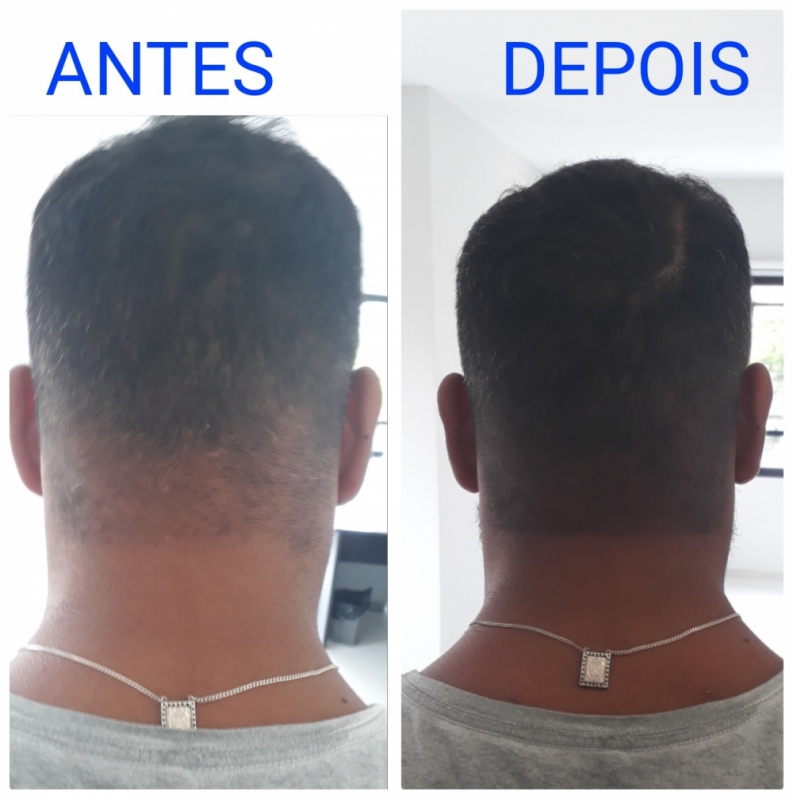 Micropigmentação Capilar Cabelo Branco Agendar Barueri - Micropigmentação Cabelo Homem