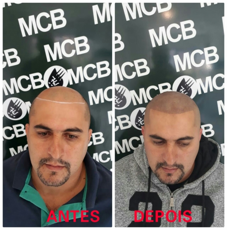 Micropigmentação Capilar em Entradas Preço José Bonifácio - Micropigmentação Capilar para Homens