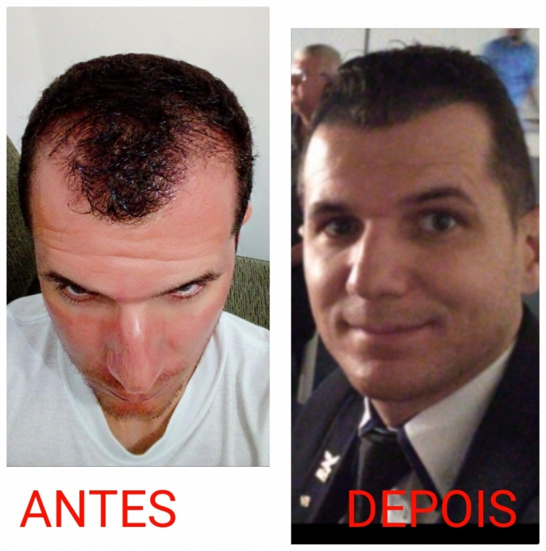 Micropigmentação Capilar Fio a Fio 3d Agendar Freguesia do Ó - Micropigmentação Capilar Cabelo Branco