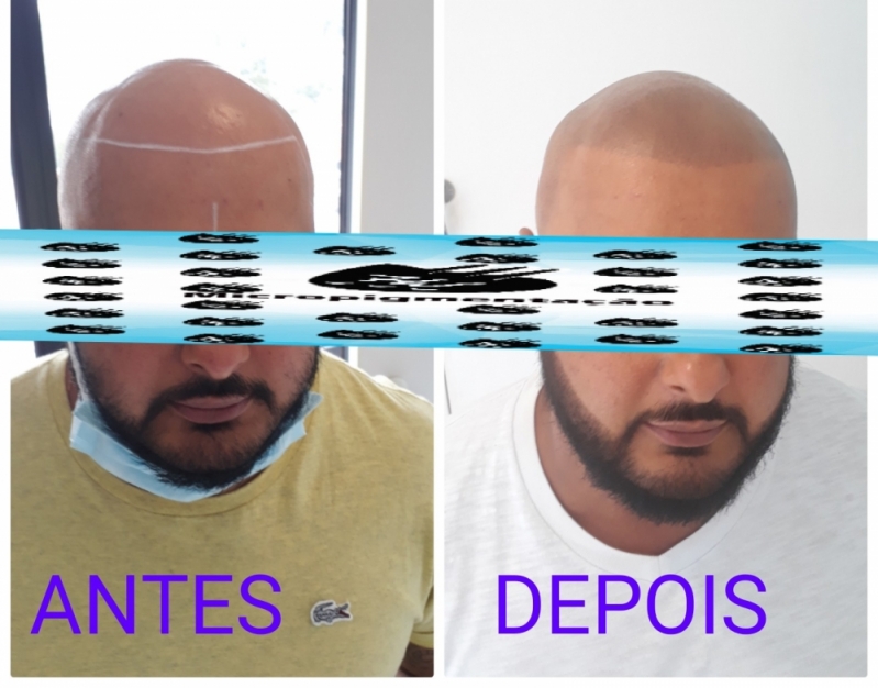 Micropigmentação Capilar Fio a Fio 3d Itanhaém - Micropigmentação de Cabelo Masculino