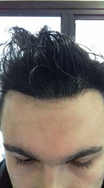 Micropigmentação Capilar para Entradas Jabaquara - Micropigmentação Capilar Masculina