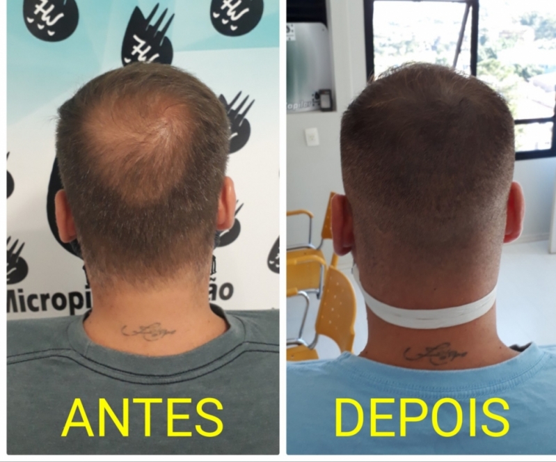 Micropigmentação Capilar Realista Preço Tatuapé - Micropigmentação Cabelo