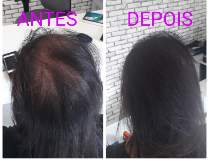 Micropigmentação de Cabelo 3d Preço Vila Maria - Micropigmentação Fio a Fio Capilar