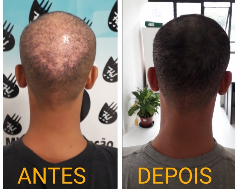 Micropigmentação de Cabelo Masculino Agendar São Caetano do Sul - Micropigmentação Preenchimento Cabelo