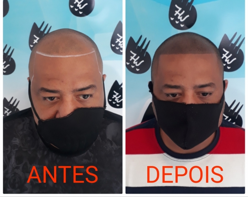 Micropigmentação Fio a Fio Cabelo Guaianases - Micropigmentação de Cabelo Masculino
