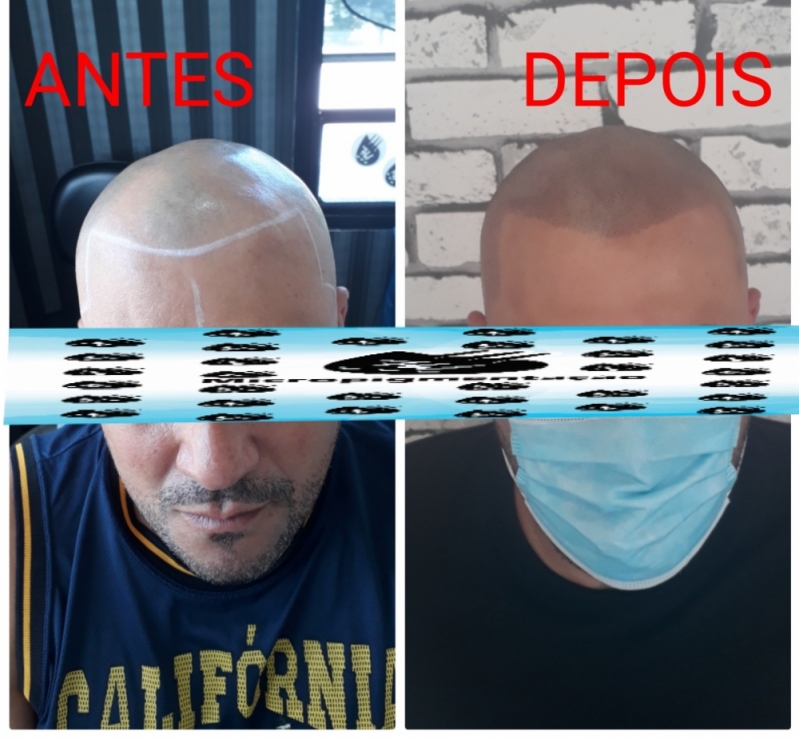 Micropigmentação Fio a Fio Capilar Higienópolis - Micropigmentação Cabelo Homem