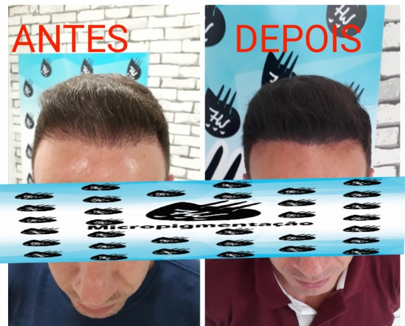 Micropigmentação no Cabelo Preço Jardins - Micropigmentação Cabelo Feminino