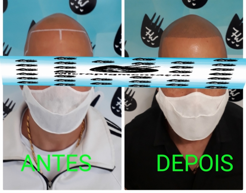 Micropigmentação no Cabelo Brooklin - Micropigmentação Capilar Realista