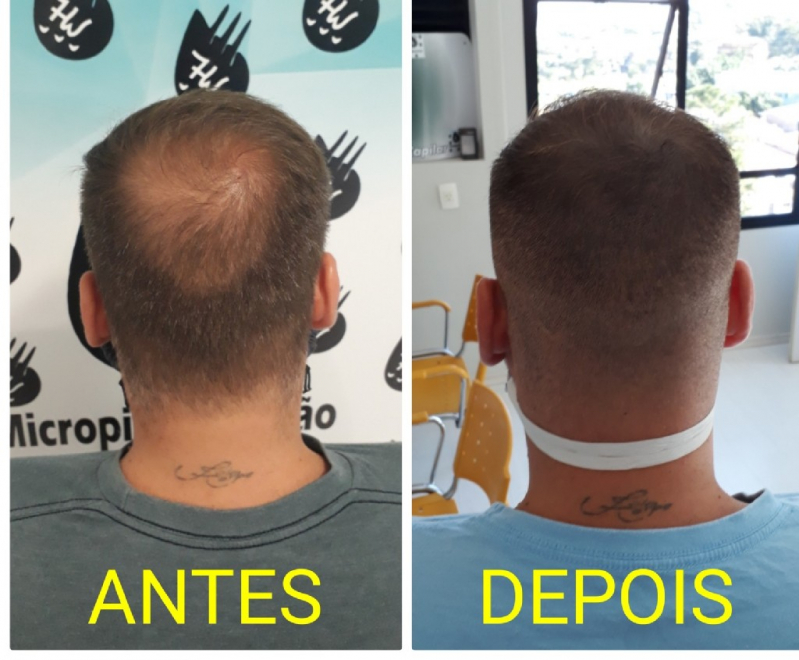 Nano Micro Capilar Valor Itaim Bibi - Nano Pigmentação de Barba ABC Paulista