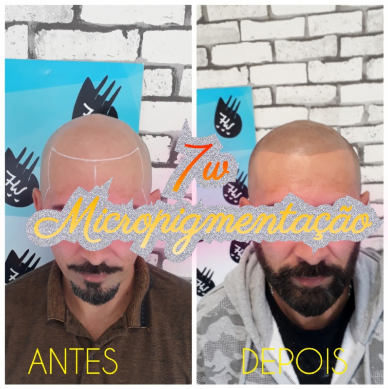 Nano Micropigmentação Capilar Preço Vila Medeiros - Nano Pigmentação de Barba ABC Paulista