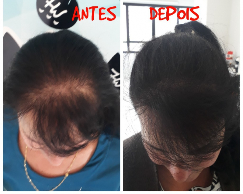 Nano Micropigmentação Capilar Sapopemba - Nano Micropigmentação na Barba Diadema