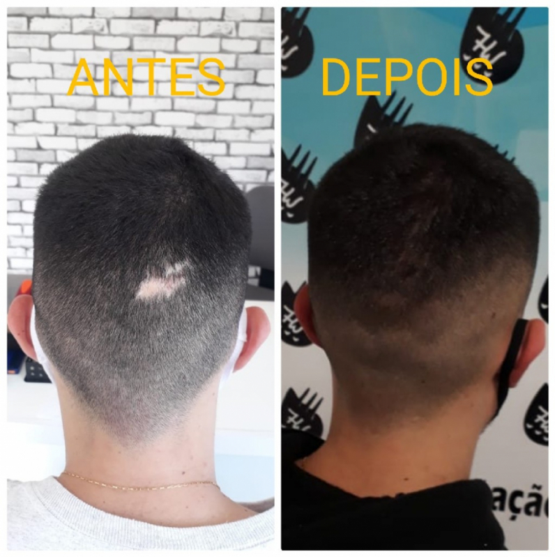 Nano Micropigmentação de Barba Preço Higienópolis - Nano Micropigmentação na Barba Diadema