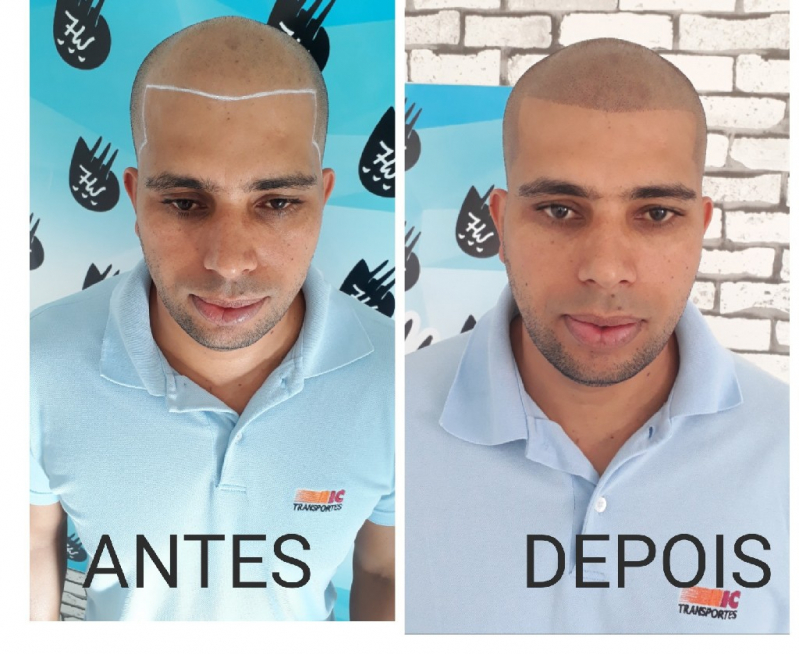 Nano Micropigmentação de Barba Vila Gustavo - Nano Micropigmentação Capilar Santo André