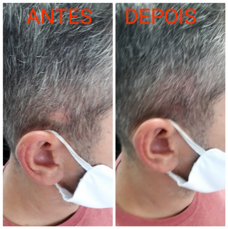 Nano Micropigmentação na Barba Preço José Bonifácio - Nano Micropigmentação Capilar Santo André