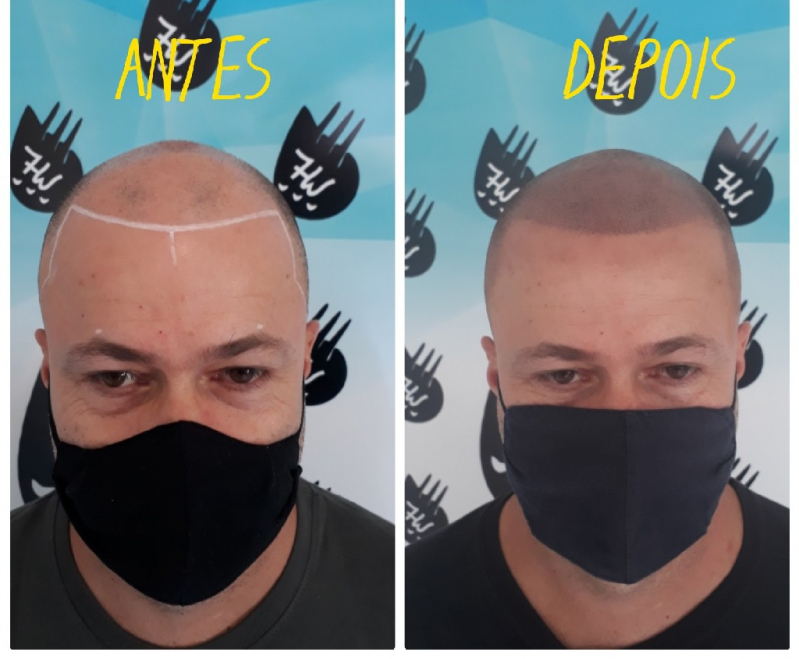 Nano Micropigmentação na Barba Barueri - Nano Micropigmentação na Barba Diadema