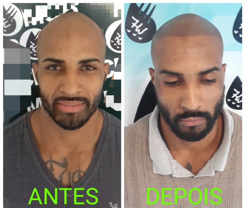 Nano Pigmentação Capilar Valor Santana de Parnaíba - Nano Pigmentação de Barba ABC Paulista