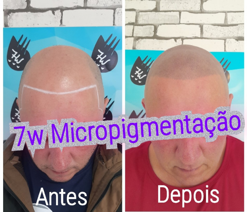 Nano Pigmentação de Barba Preço São Mateus - Nano Micropigmentação Capilar Santo André