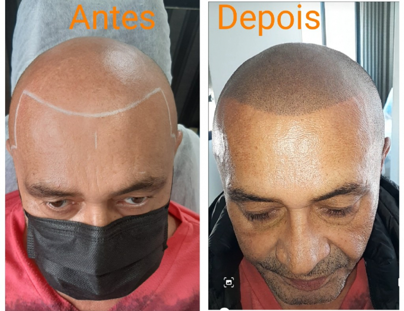 Nano Pigmentação na Barba Preço Santana - Nano Pigmentação de Barba ABC Paulista