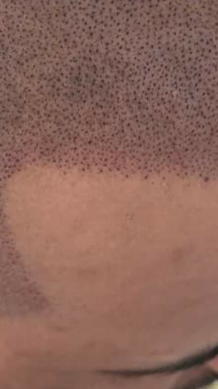 Onde Encontrar Clínica de Micropigmentação Capilar em 3d Água Rasa - Clínica de Pigmentação Capilar para Homens