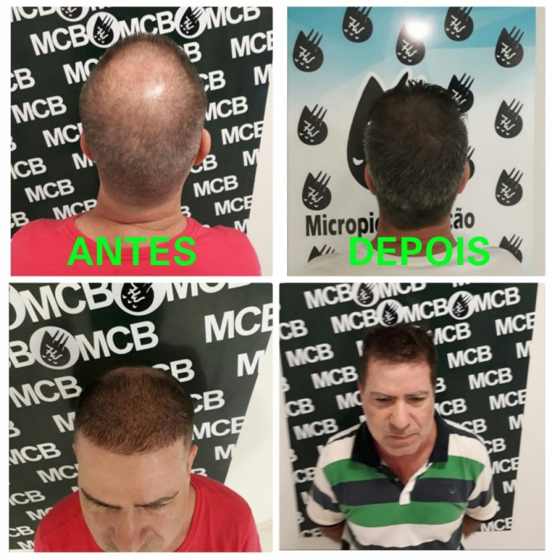 Onde Encontrar Clínica de Pigmentação Capilar em Entradas Moema - Clínica de Micropigmentação Capilar